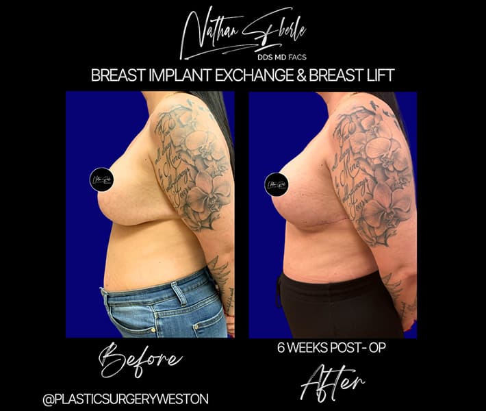 Breast Implant Exchange before and after - Actual Patient