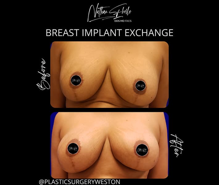 Breast Implant Exchange before and after - Actual Patient