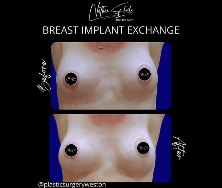 Breast Implant Exchange before and after - Actual Patient