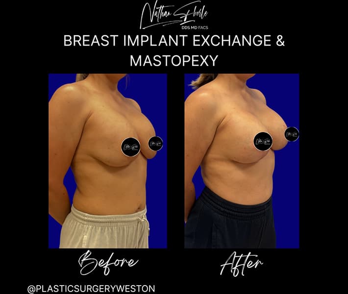 Breast Implant Exchange before and after - Actual Patient