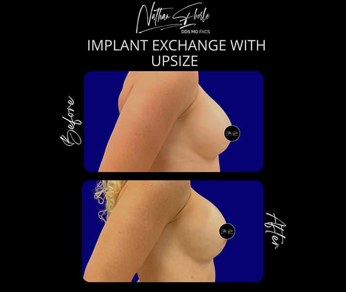 Breast Implant Exchange before and after - Actual Patient