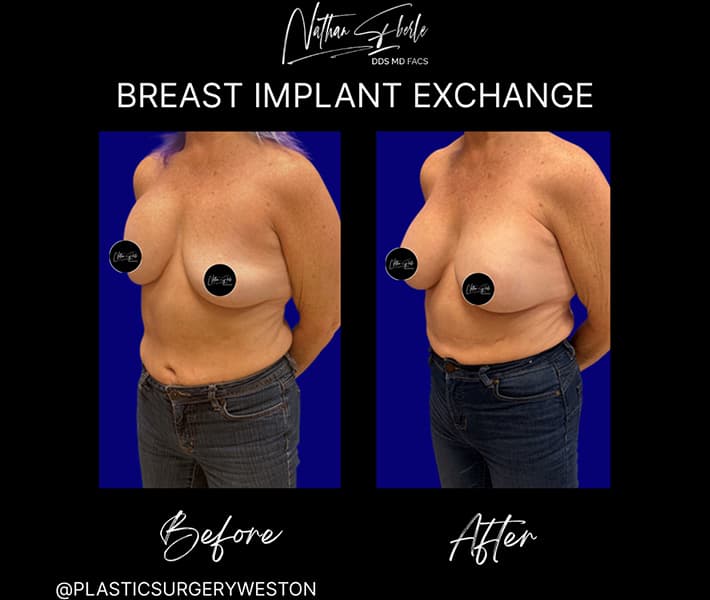 Breast Implant Exchange before and after - Actual Patient