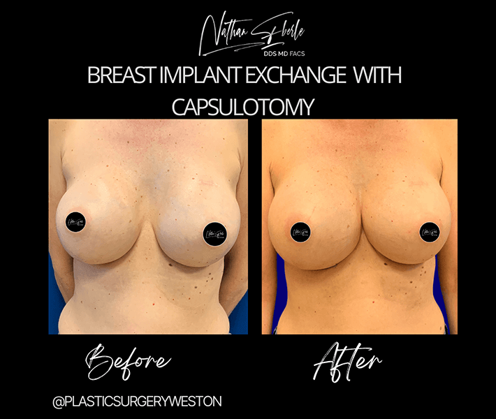 Breast Implant Exchange before and after - Actual Patient