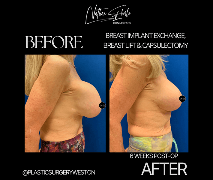 Breast Implant Exchange before and after - Actual Patient
