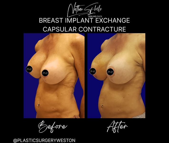 Breast Implant Exchange before and after - Actual Patient
