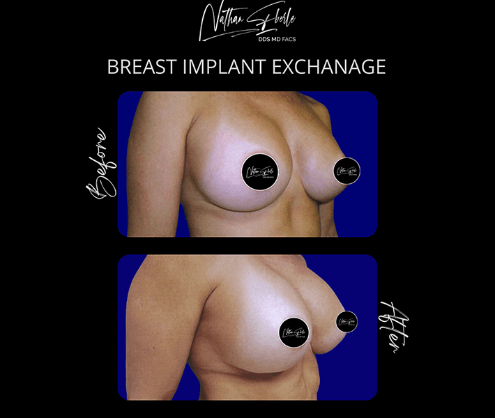 Breast Implant Exchange before and after - Actual Patient