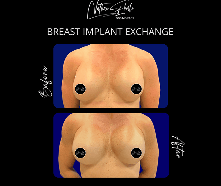 Breast Implant Exchange before and after - Actual Patient