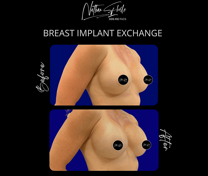 Breast Implant Exchange before and after - Actual Patient