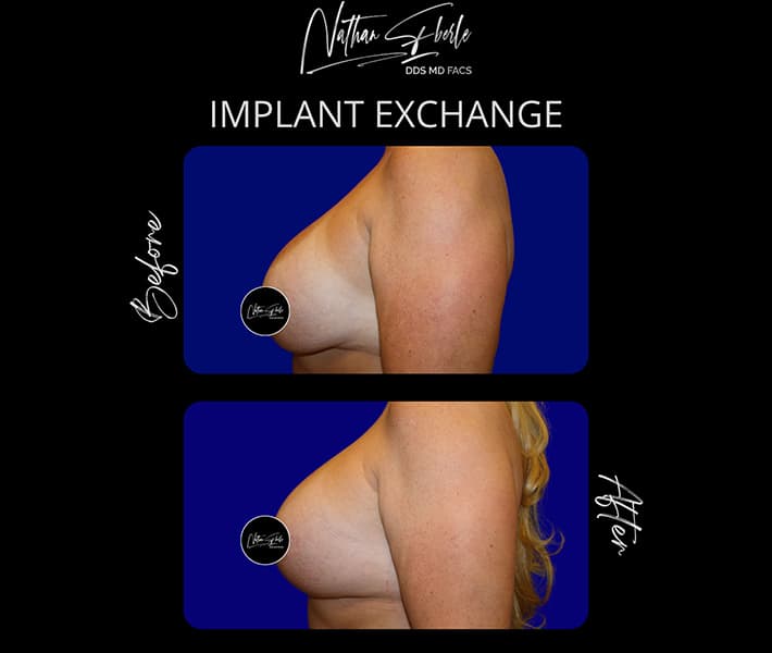 Breast Implant Exchange before and after - Actual Patient