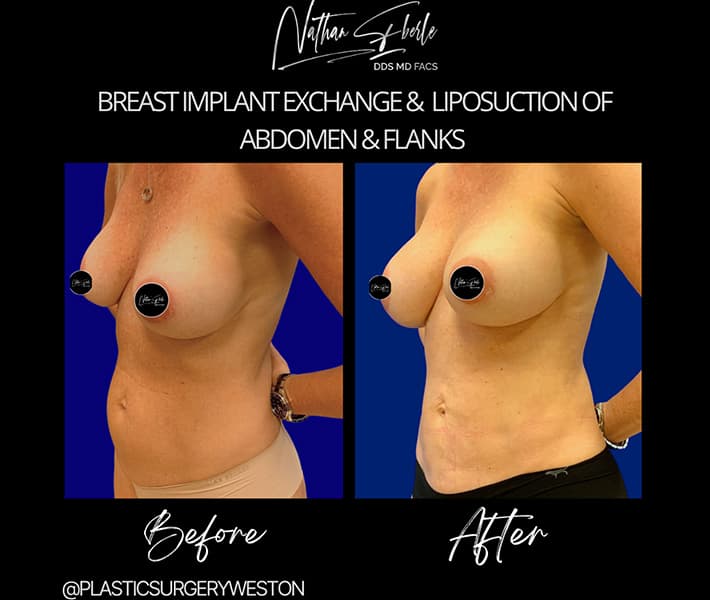 Breast Implant Exchange before and after - Actual Patient