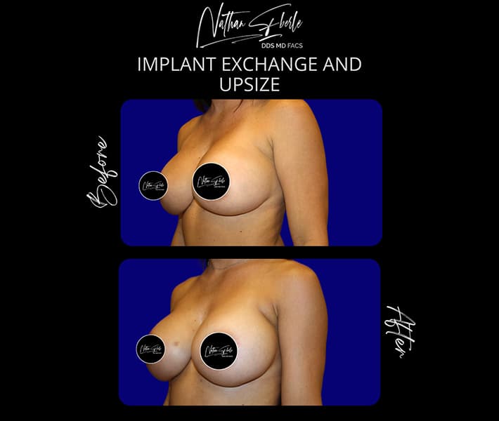 Breast Implant Exchange before and after - Actual Patient