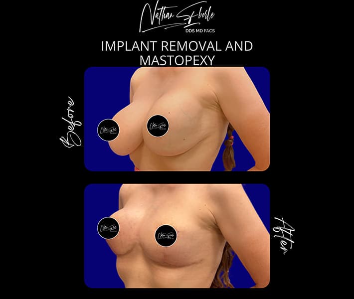 Breast Implant Removal before and after - Actual Patient