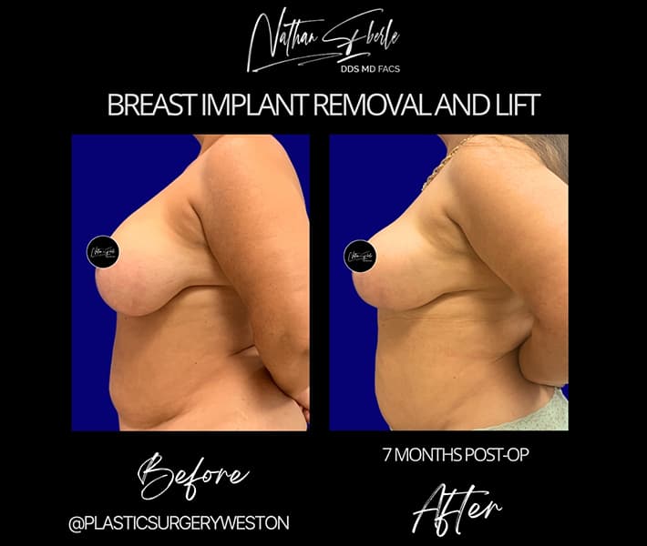 Breast Implant Removal before and after - Actual Patient