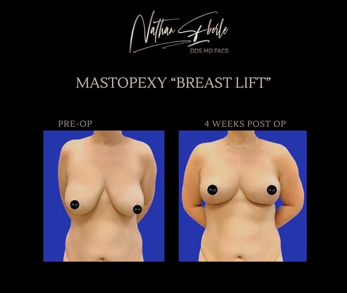 Breast Lift before and after - Actual Patient