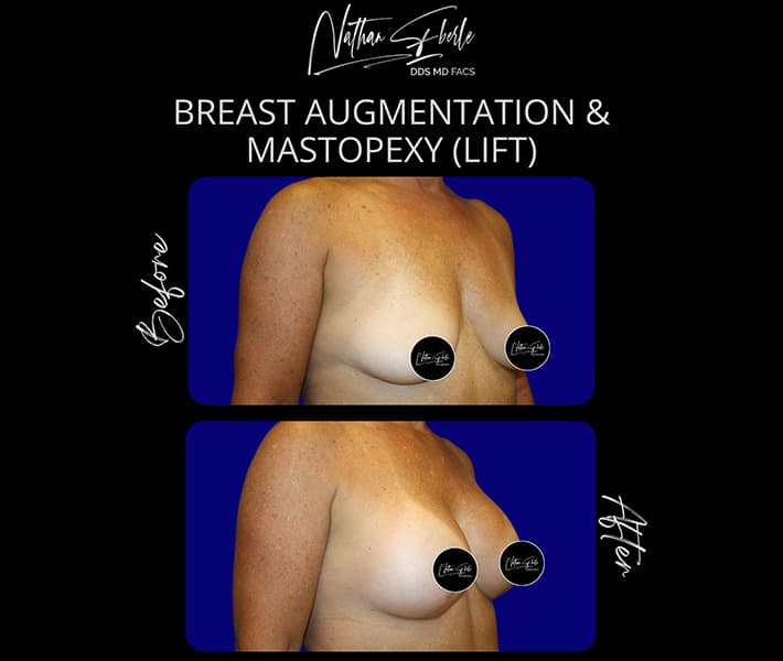 Breast Lift before and after - Actual Patient