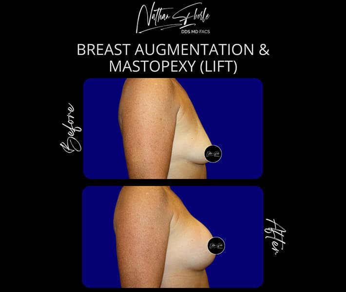 Breast Lift before and after - Actual Patient