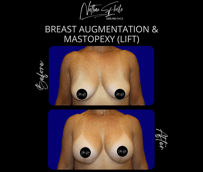 Breast Lift before and after - Actual Patient