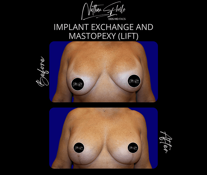 Breast Lift before and after - Actual Patient