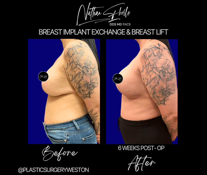 Breast Lift before and after - Actual Patient