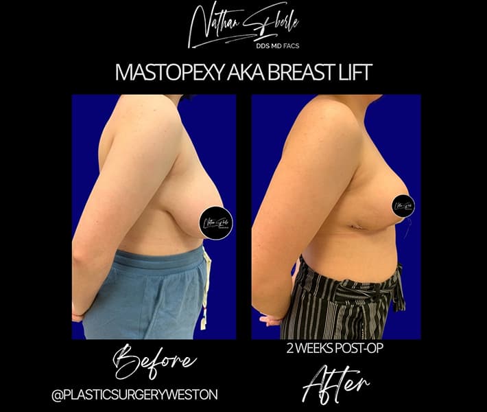 Breast Lift before and after - Actual Patient