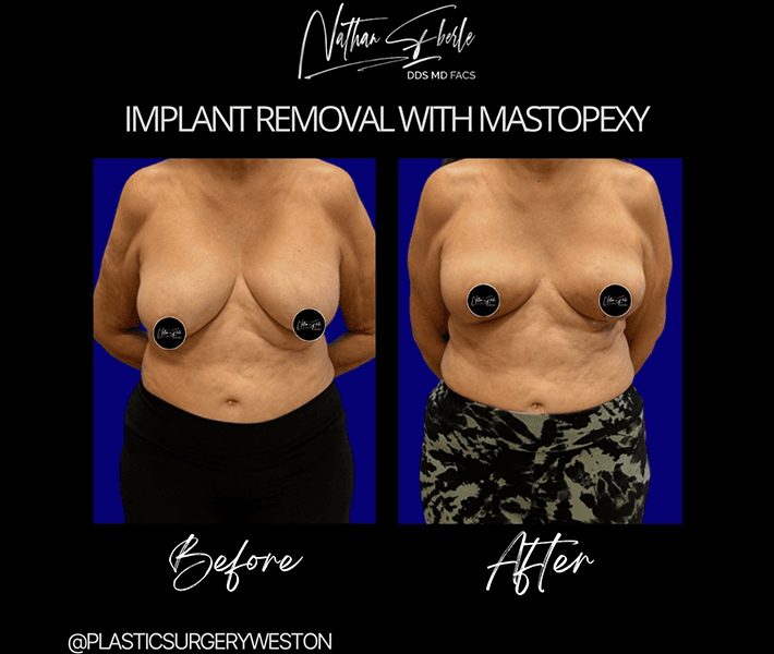 Breast Lift before and after - Actual Patient