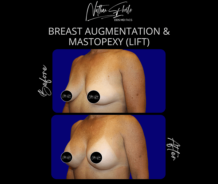 Breast Lift before and after - Actual Patient