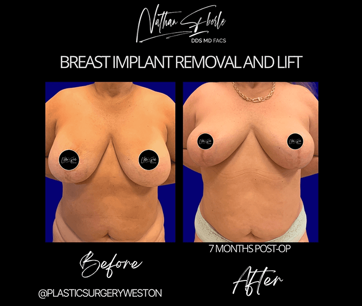 Breast Lift before and after - Actual Patient