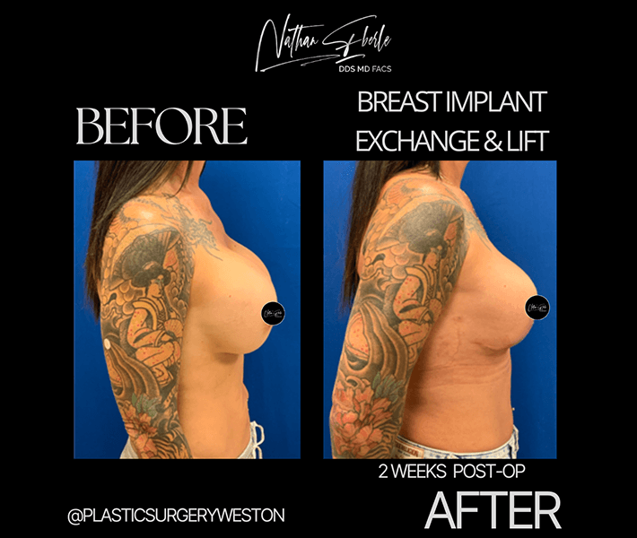 Breast Lift before and after - Actual Patient