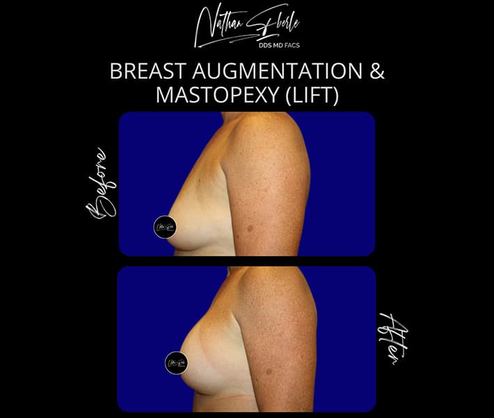 Breast Lift before and after - Actual Patient