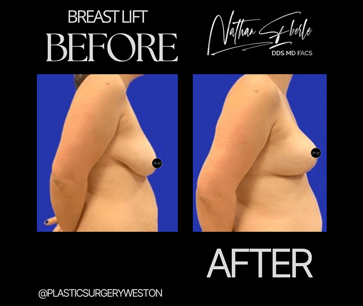 Breast Lift before and after - Actual Patient