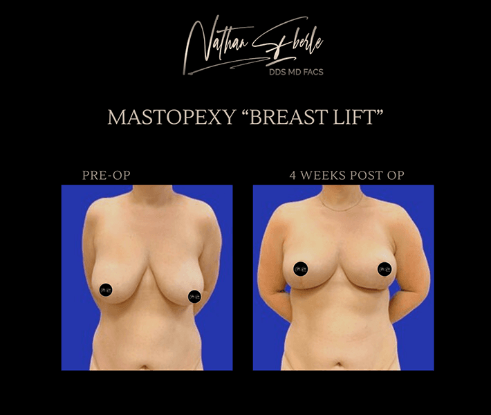 Breast Lift before and after - Actual Patient