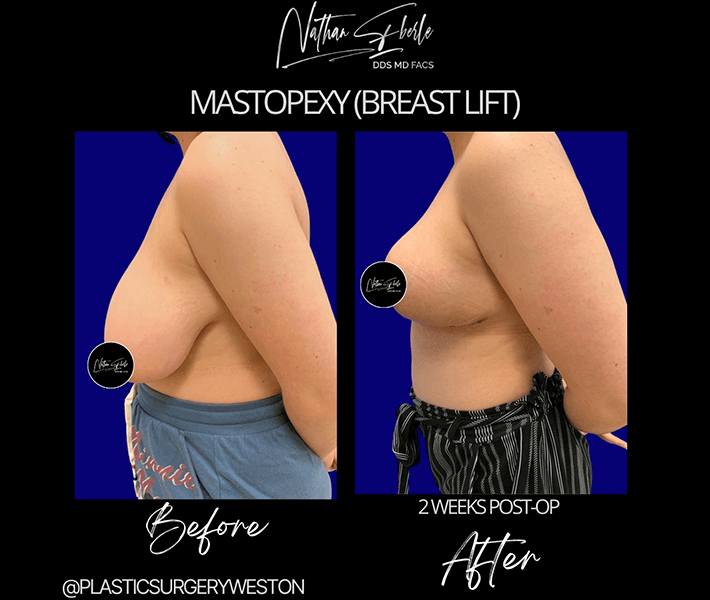 Breast Lift before and after - Actual Patient