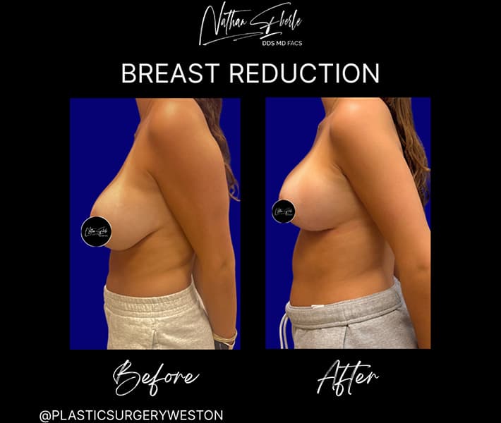 Breast Reduction before and after - Actual Patient