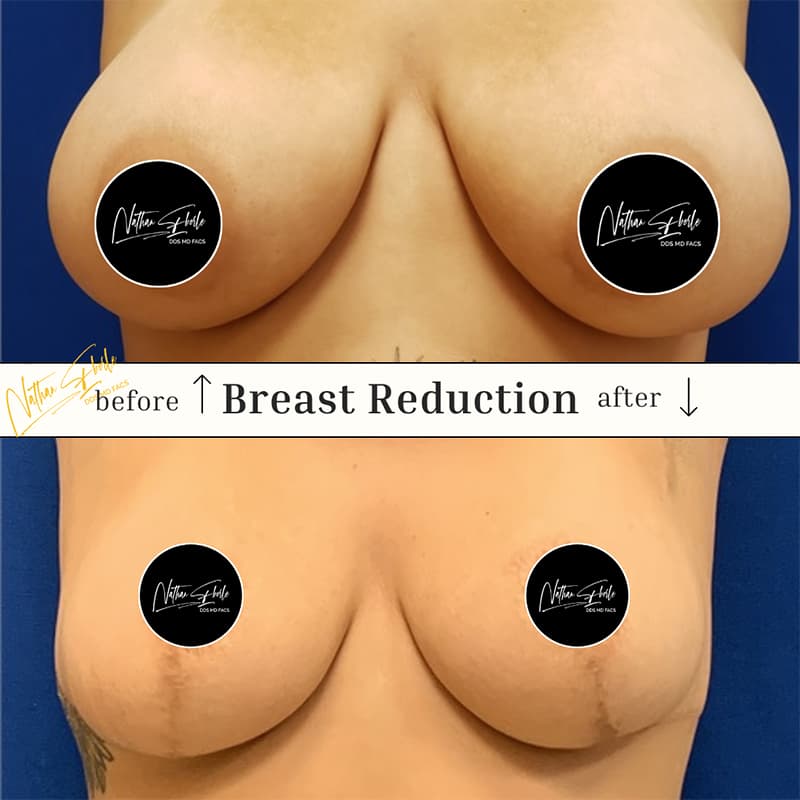 Breast Reduction before and after - Actual Patient