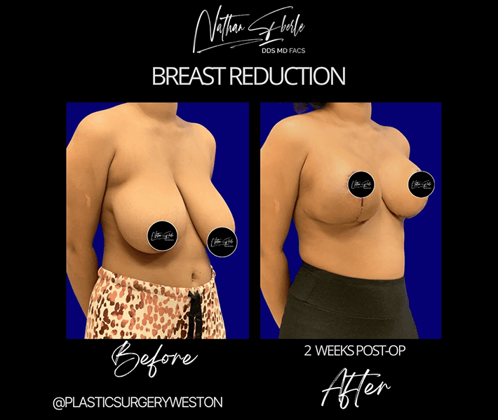 Breast Reduction before and after - Actual Patient