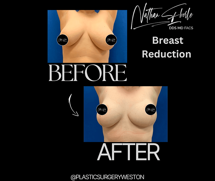 Breast Reduction before and after - Actual Patient