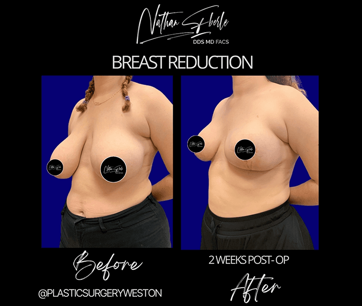 Breast Reduction before and after - Actual Patient