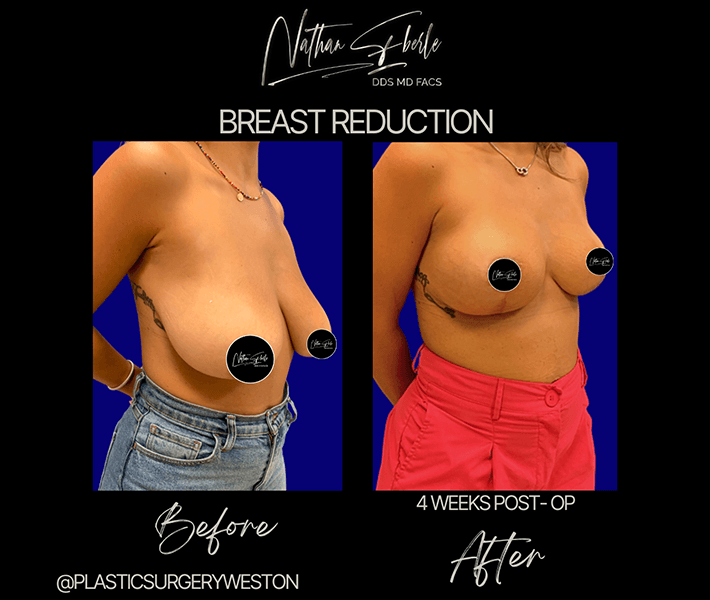 Breast Reduction before and after - Actual Patient
