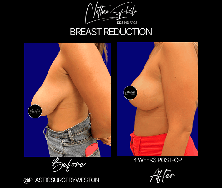 Breast Reduction before and after - Actual Patient