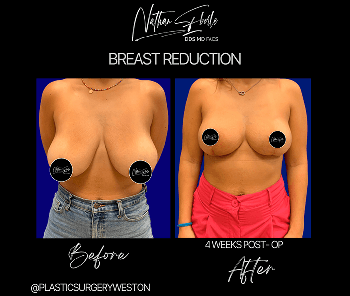 Breast Reduction before and after - Actual Patient
