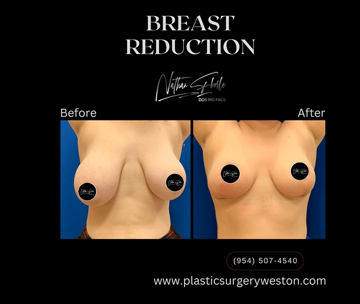 Breast Reduction before and after - Actual Patient