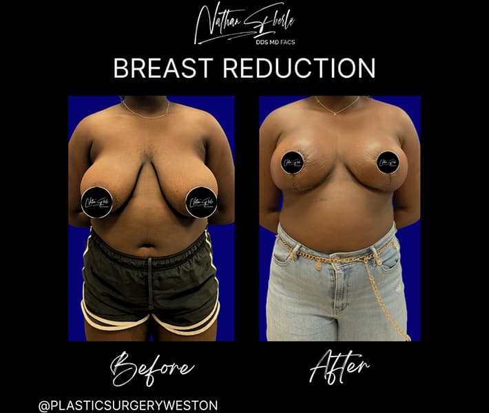 Breast Reduction before and after - Actual Patient