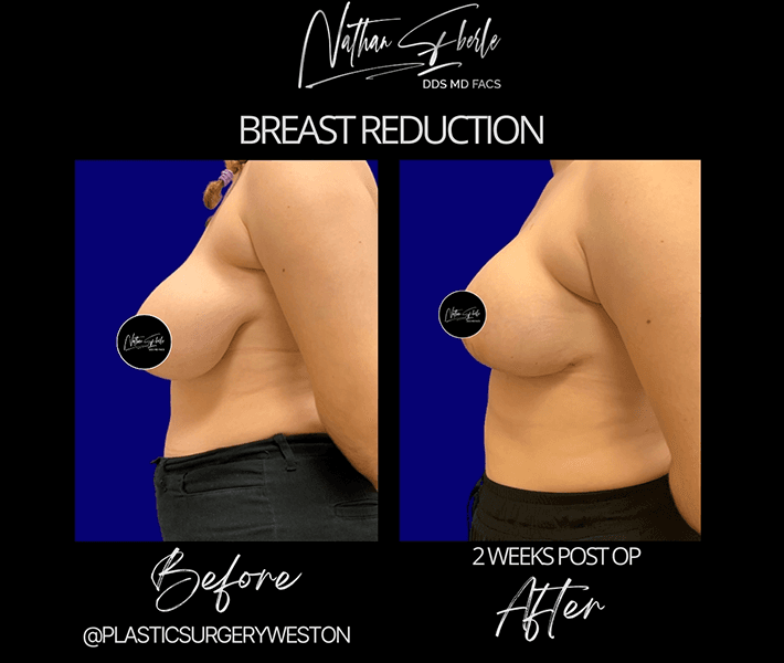 Breast Reduction before and after - Actual Patient