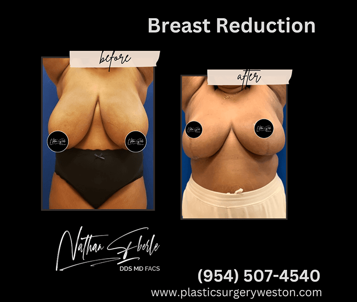 Breast Reduction before and after - Actual Patient