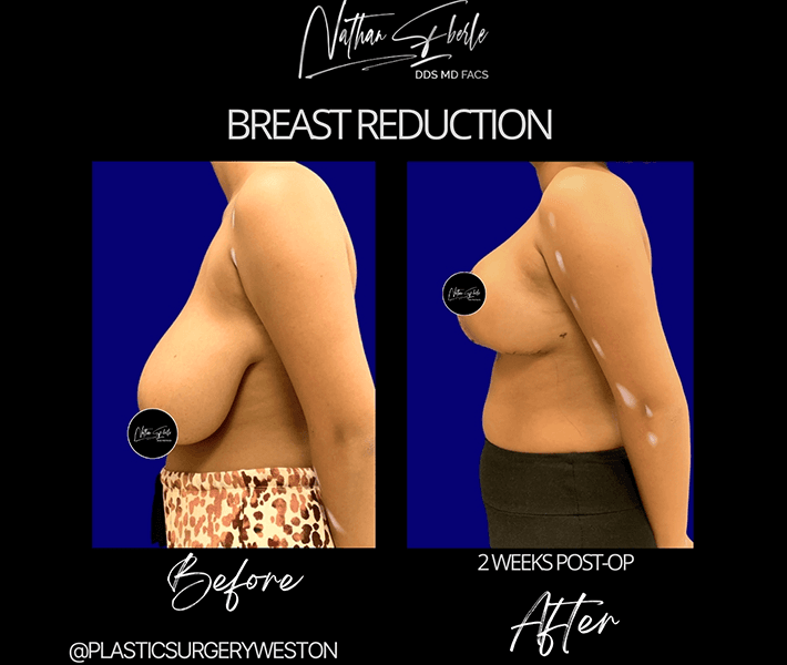 Breast Reduction before and after - Actual Patient
