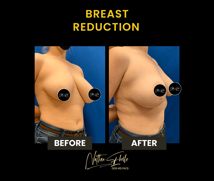 Breast Reduction before and after - Actual Patient