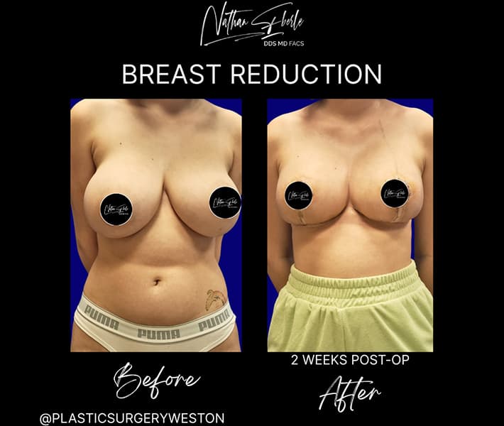 Breast Reduction before and after - Actual Patient