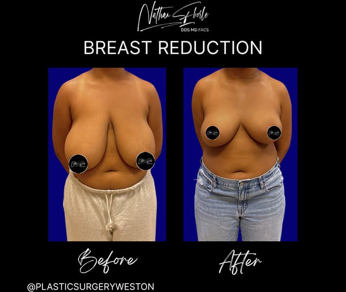 Breast Reduction before and after - Actual Patient