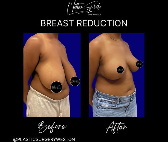 Breast Reduction before and after - Actual Patient