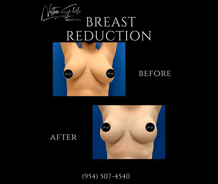 Breast Reduction before and after - Actual Patient